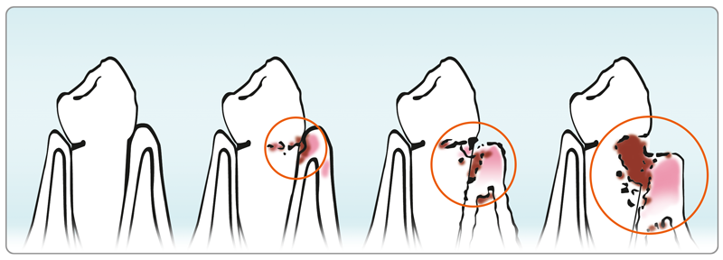 Parodontalbehandlung