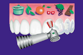 Politur der Zahnoberfläche mit fluoridierter Polierpaste